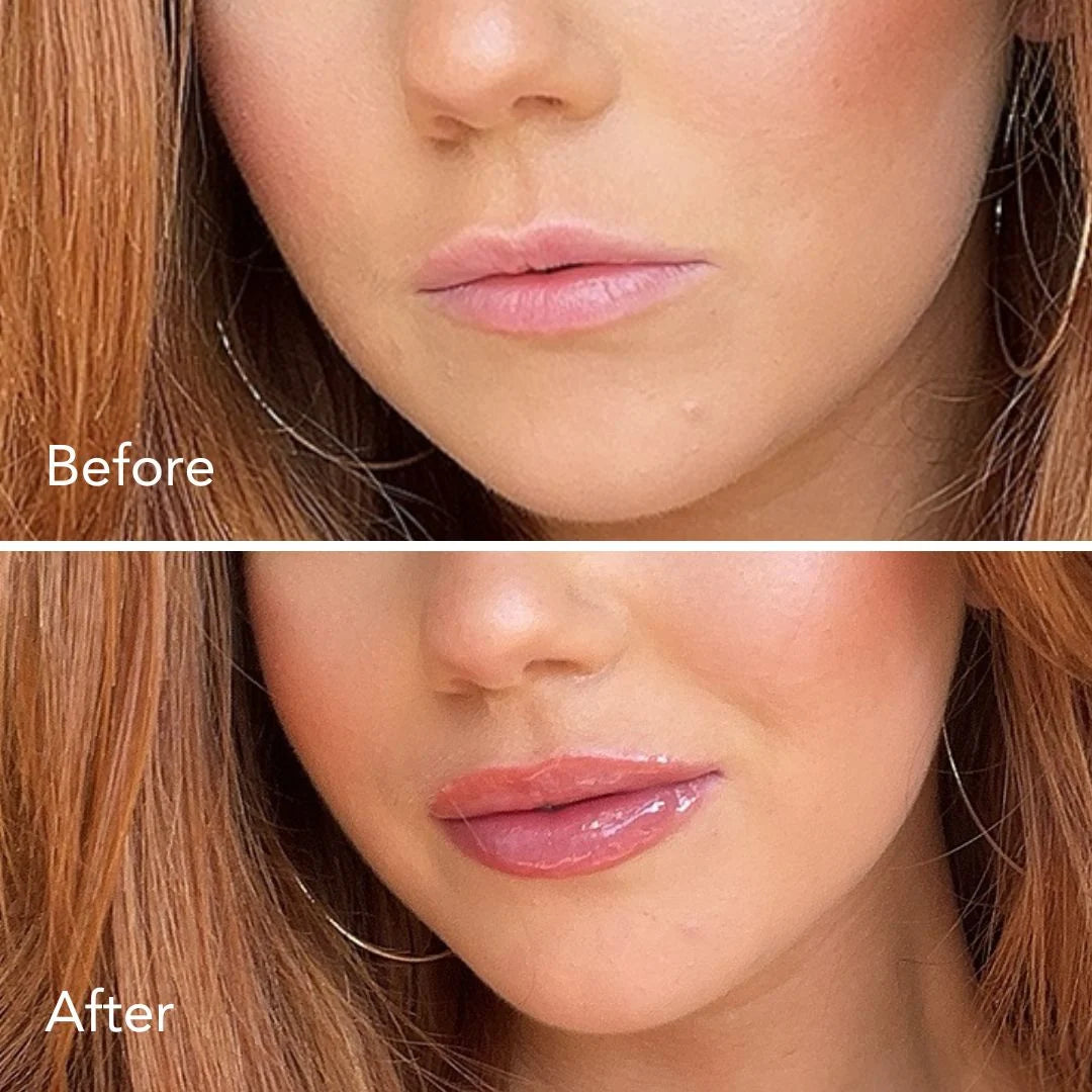 Smooche Normal Lip Plumper before and after images after the plumper  is applied