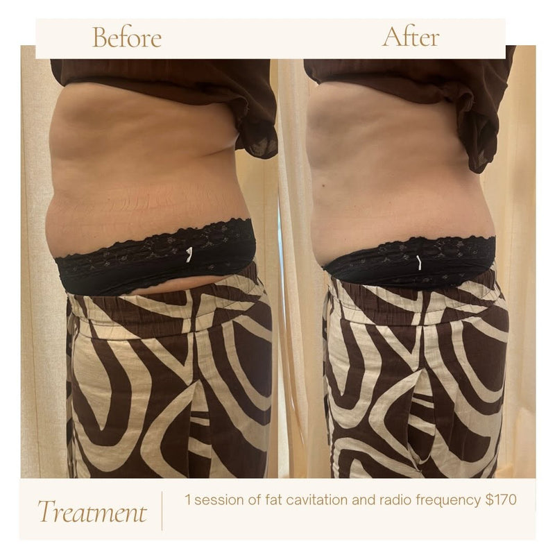 Fat cavitation + radio frequency,