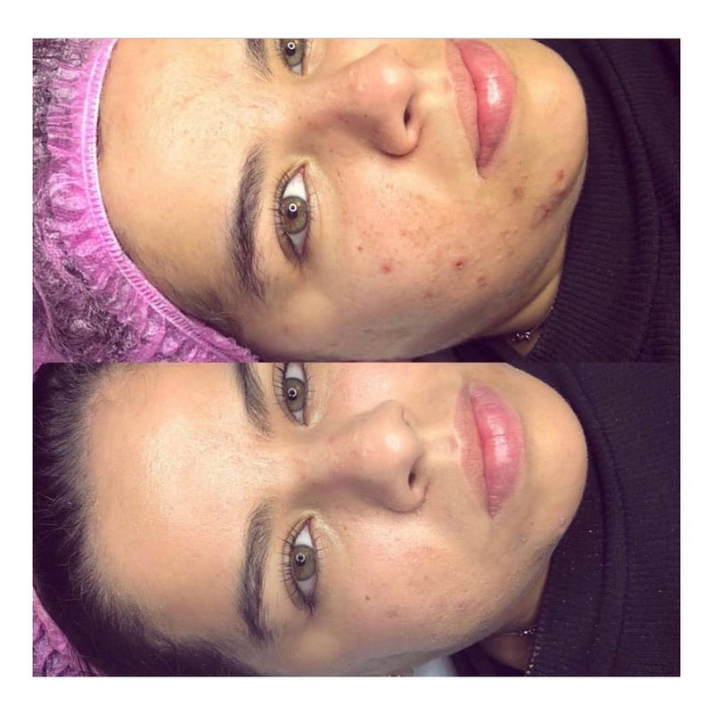 DERMAPLANING