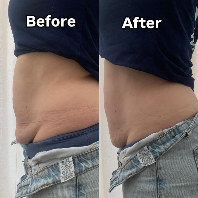 Fat Cavitation and Radio Frequency and ems combo!