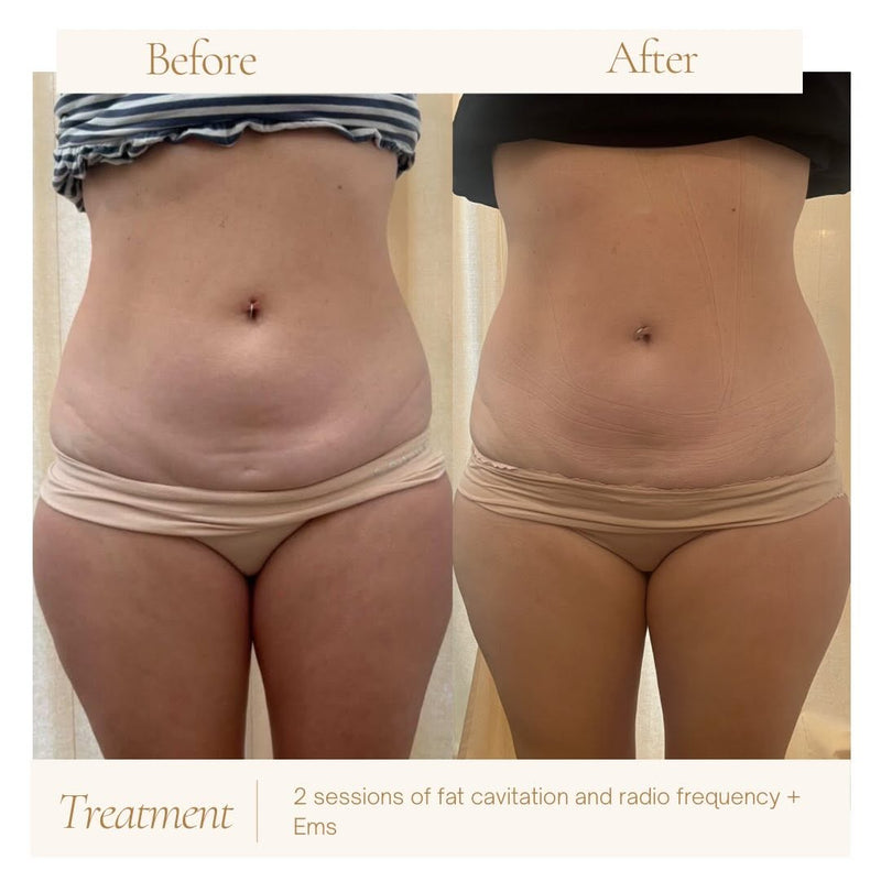 fat cavitation + EMS