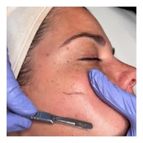 DERMAPLANING