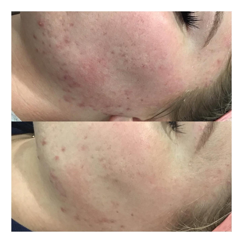 Microneedling Reduces Scars from Acne 