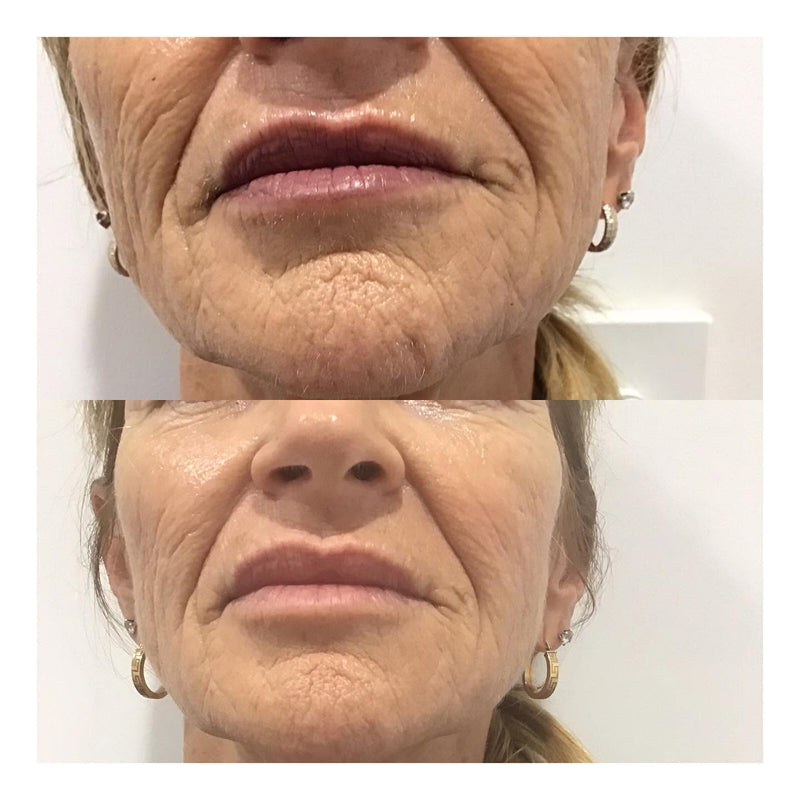 Plasma skin tightening, or plasma skin resurfacing